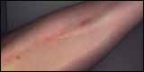 Scarred for life